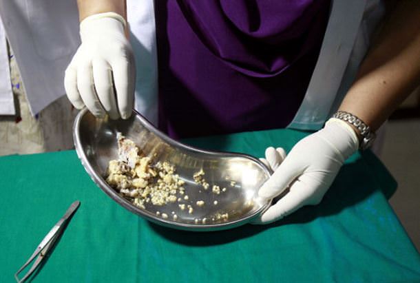 extraen_232_dientes_05