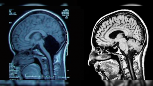 El extraño caso de una mujer sin cerebelo