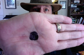 Campaña del punto negro en la mano